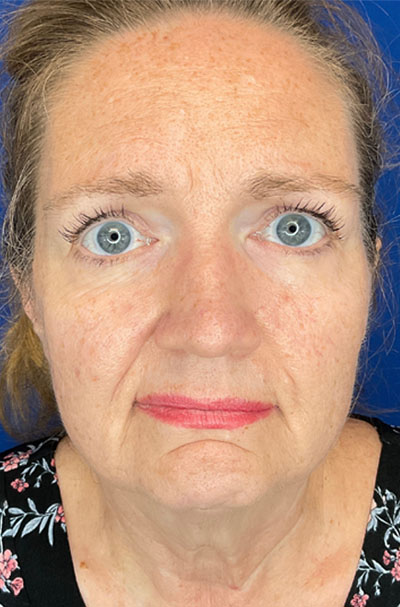 Real patient Facelift before photo
